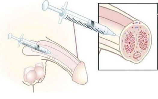 Injoyment des injections d'acide hyaluronique