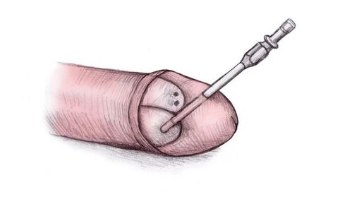 La tête du pénis peut être agrandie en y injectant du gel hyaluronique