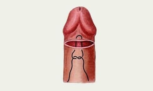 gland pénis