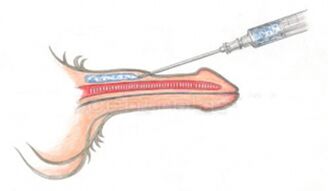 Injection volumatrice d'acide hyaluronique dans le pénis